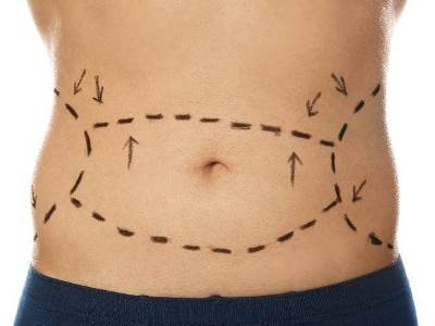 „Fogyasztó” műtét? 8 gyakori tévhit a zsírleszívásról - dr. Pataki Gergely plasztikai sebész